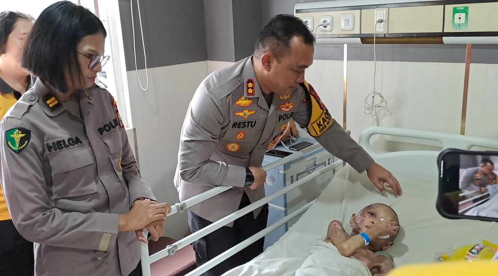 Polres Pelabuhan Makassar Selamatkan Bocah dengan Tubuh Penuh Luka Bakar